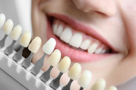 Modell mit Zähnen vor einem Gebiss zur Entscheidung der Zahnfarbe und Größe beim Bleaching, Einsatz von Non-Prep-Veneers oder Zahnersatz