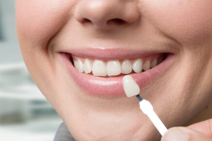 Modell mit Zähnen vor einem Gebiss zur Entscheidung der Zahnfarbe und Größe beim Bleaching oder Einsatz von Non-Prep-Veneers