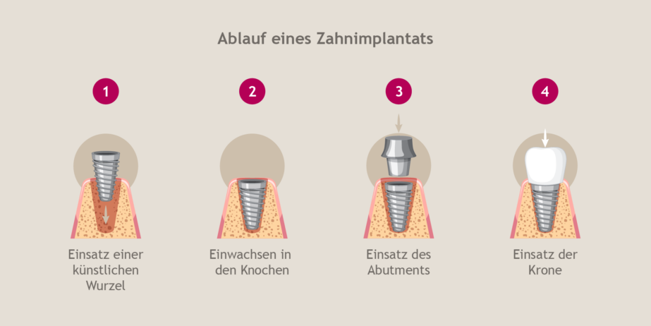 Ihr Zahnarzt für Implantate berät Sie, ob Implantate als Zahnersatz für Sie richtig sind.